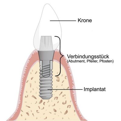 prof dhom zahnimplantat - Sofortimplantation - kaputter Zahn raus, neues Implantat rein, am gleichen Tag