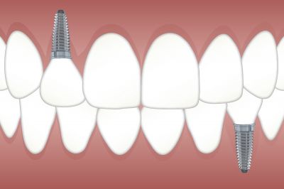 zahn implantate - Wie pflegt man Zahnimplantate richtig, und halten sie dadurch länger?
